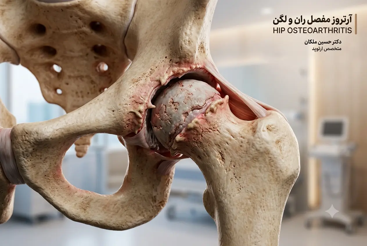 آرتروز لگن و ران