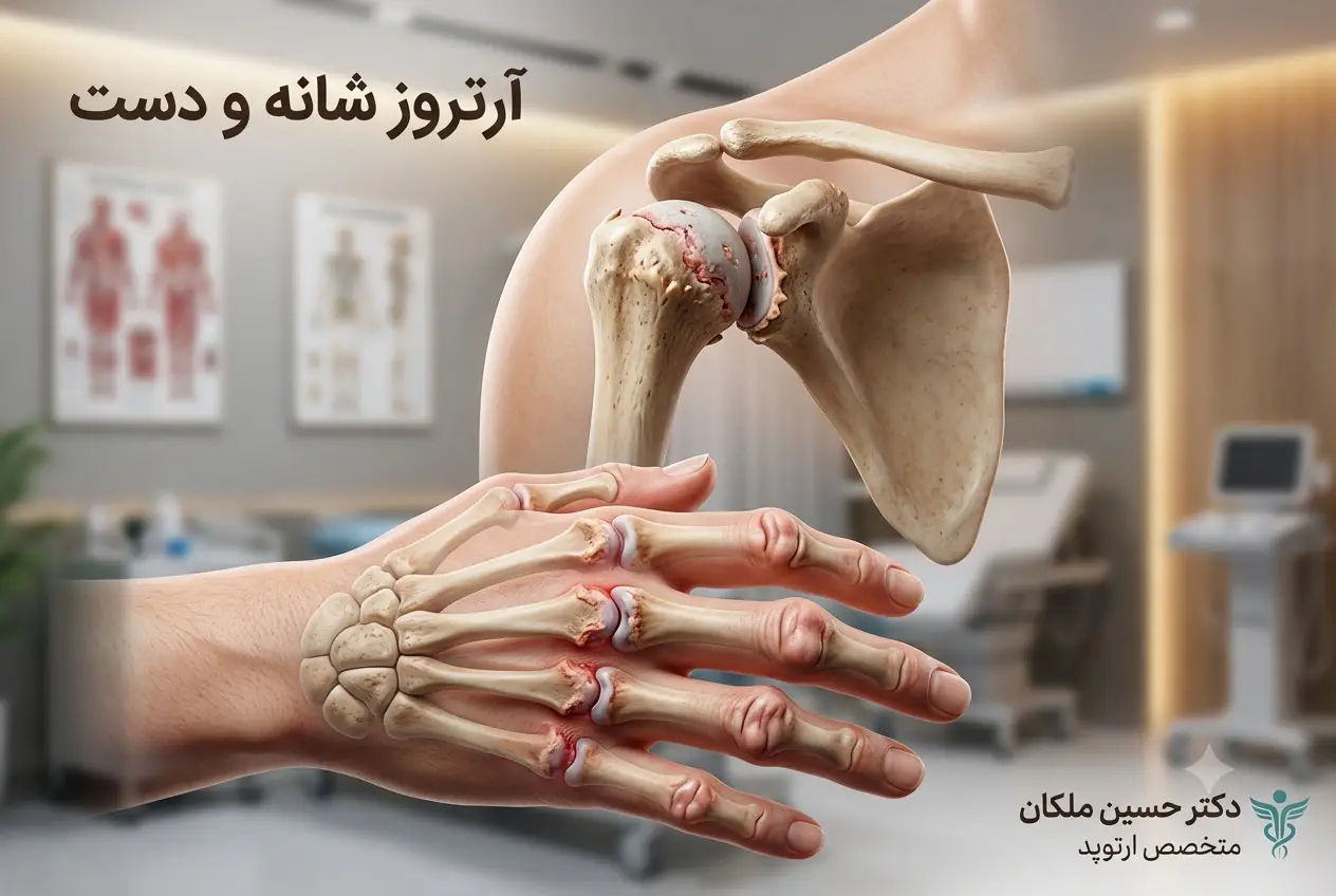 آرتروز شانه و دست