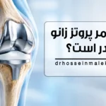 طول عمر پروتز زانو چقدر است؟
