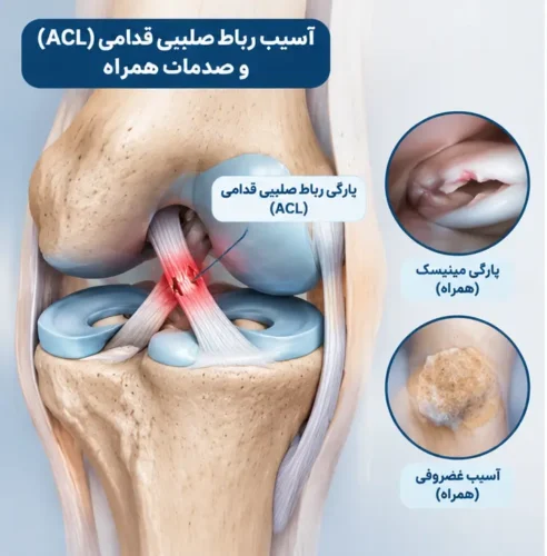 آسیب رباط صلیبی قدامی (ACL) و صدمات همراه