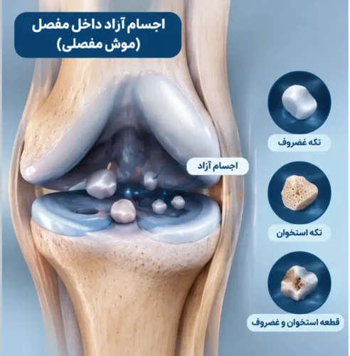 اجسام آزاد داخل مفصل (موش مفصلی)