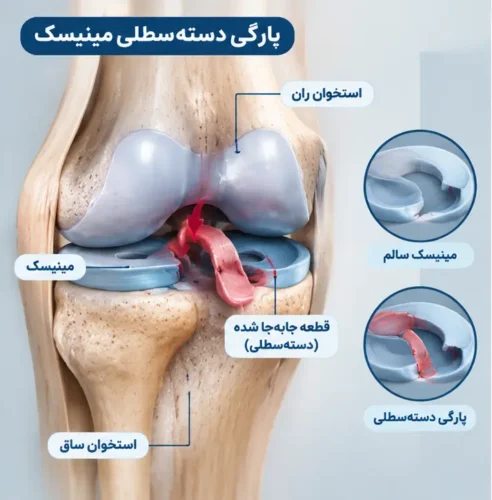 پارگی جابه‌جا شده مینیسک، به‌ویژه پارگی دسته‌سطلی